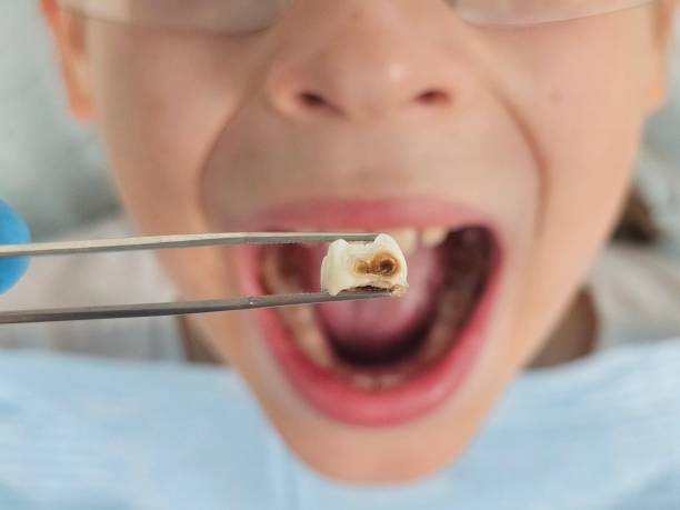 Best Emergency Root Canal Treatment in Port Oconnor, TX